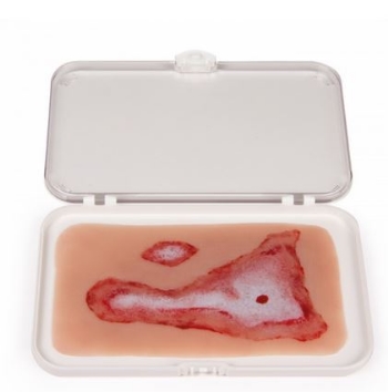 Wundmoulage Verbrühung
